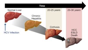 مراحل آسیب کبدی در هپاتیت C مزمن